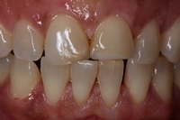 Επιμήκυνση δοντιών με χρήση σύνθετης ρητίνης